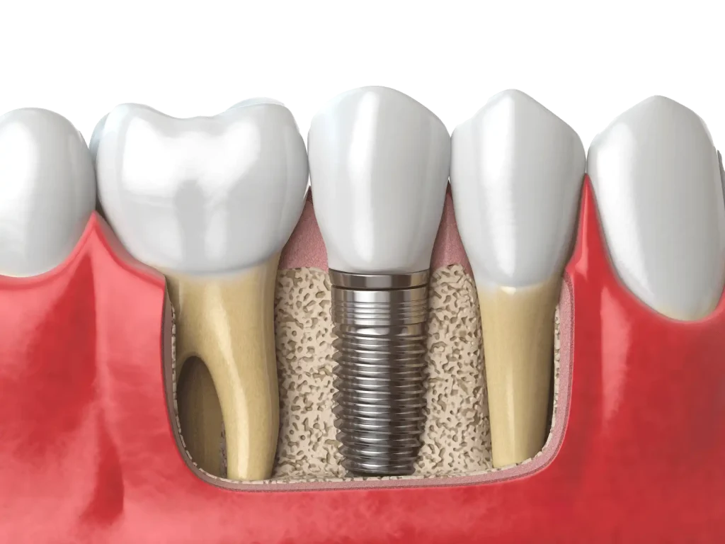 Implantes Dentales