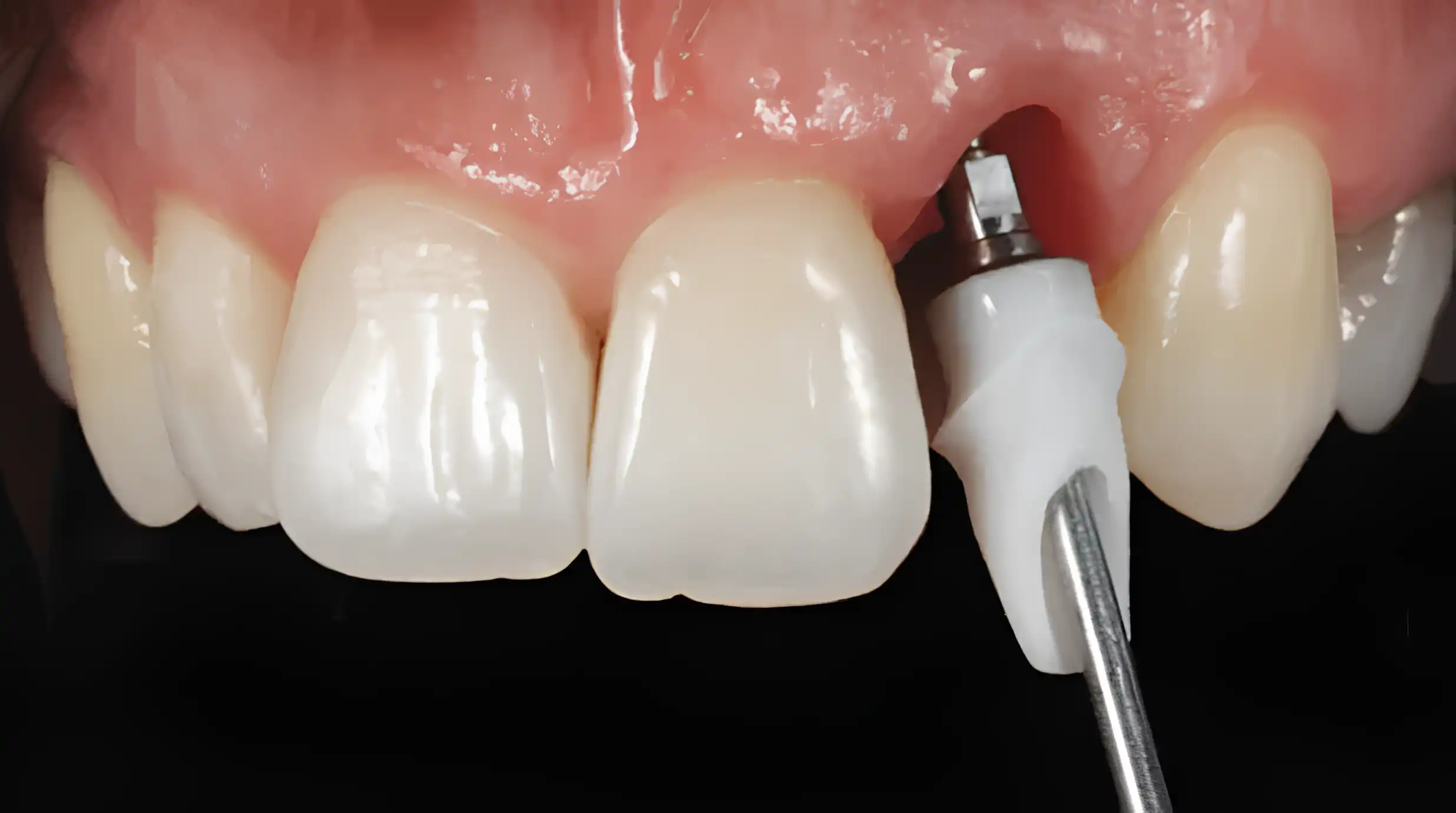 Implantes Dentales